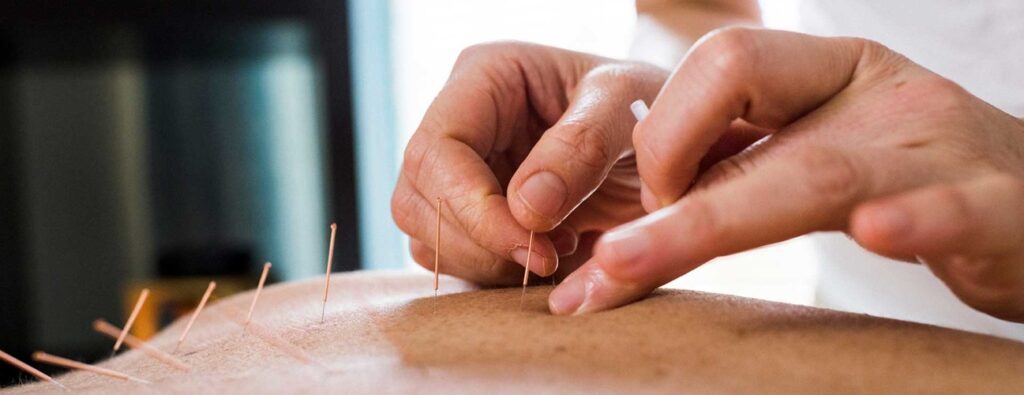 Acupuncture