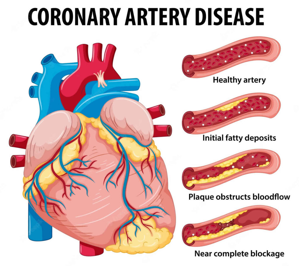 Coronary Artery Disease Part : 2